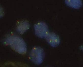 FISH Probes Assist in Lung Cancer Diagnosis