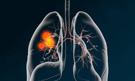 Risk of Lung Cancer Recurrence Linked to ctDNA Levels