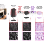 Virtual Histology Eliminates Need for Invasive Skin Biopsies
