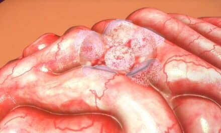 Rapid Cerebrospinal Fluid Test Decreases Time for Brain Tumors Diagnosis