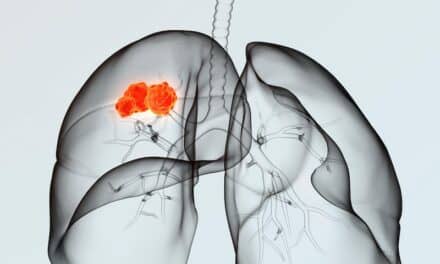 New Test Influences First-Line Therapy Decisions for Metastatic NSCLC Patients