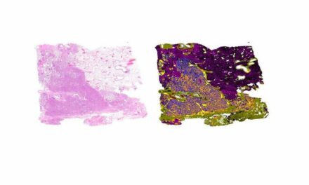 AI-Powered Digital Pathology Platform Aids Lung Cancer Diagnosis